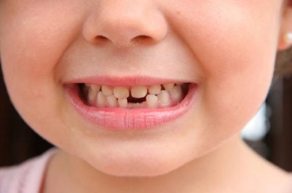A close-up view of a child's smile showcasing a gap where a tooth is missing, highlighting their youthful charm.